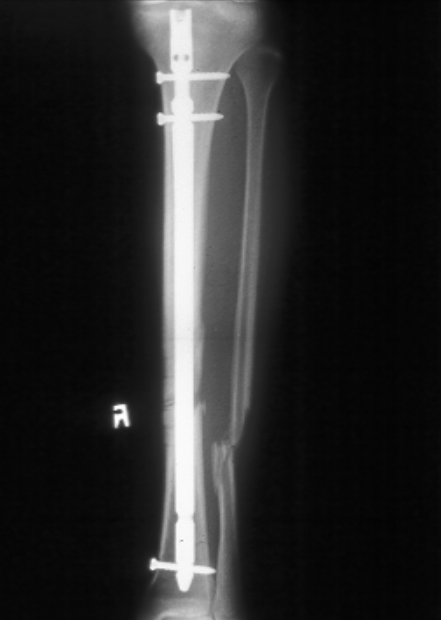 Tibial shaft IM.jpg